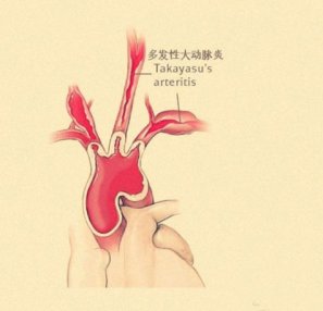 多发性大动脉炎