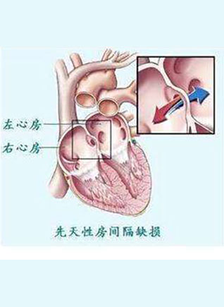 成人先天性心脏病