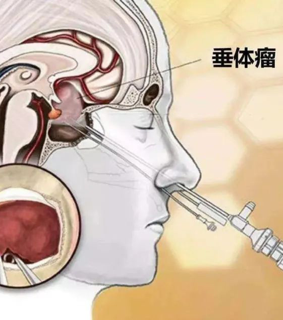 脑垂体瘤导致头痛、视力下降，颞侧视野偏盲