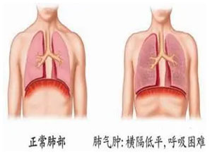 肺气肿