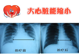 心肌病心衰